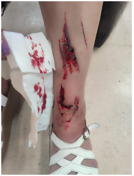 fotografía donde se aprecian cortaduras en una pierna